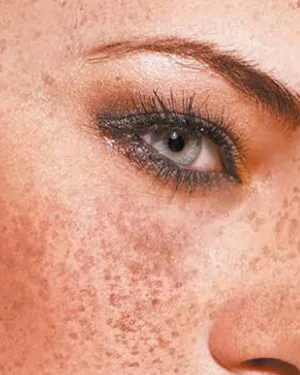 5 Ways to Better Cope With Melasma